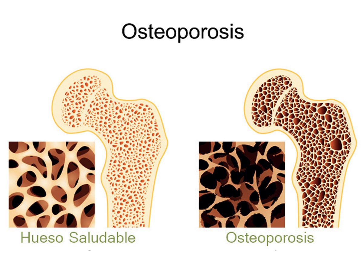 Osteoporosis significa “Hueso poroso”, y afecta con mayor intensidad a las mujeres. Crédito de foto: Organización Mundial de la Salud (OMS).