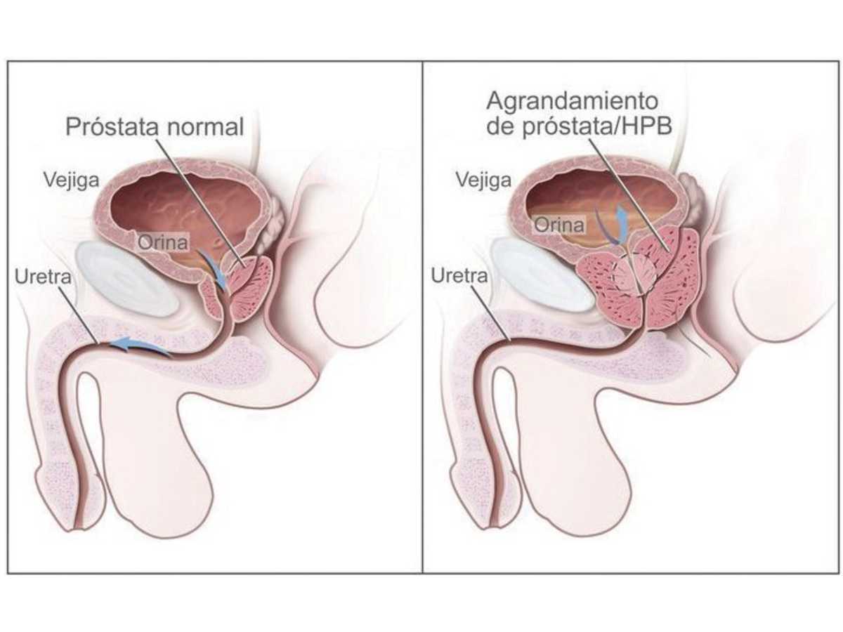 Una próstata no obstruye el flujo de la orina desde la vejiga (izquierda), mientras que el agrandamiento de la próstata ejerce presión sobre la vejiga y la uretra, y obstruye el flujo de la orina (derecha). Crédito de la foto: cancer.gov  